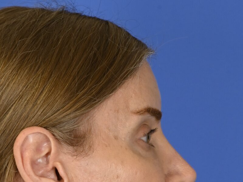 Brow Bossing Reduction Before & After Image