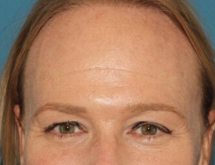 Brow Lift Before & After Image