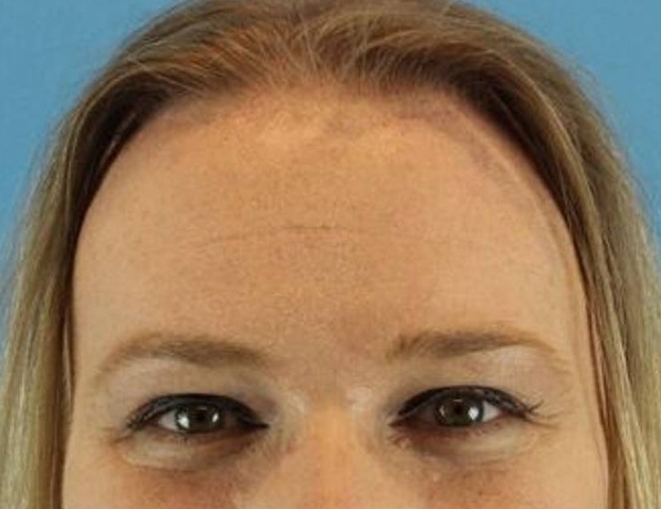 Brow Lift Before & After Image