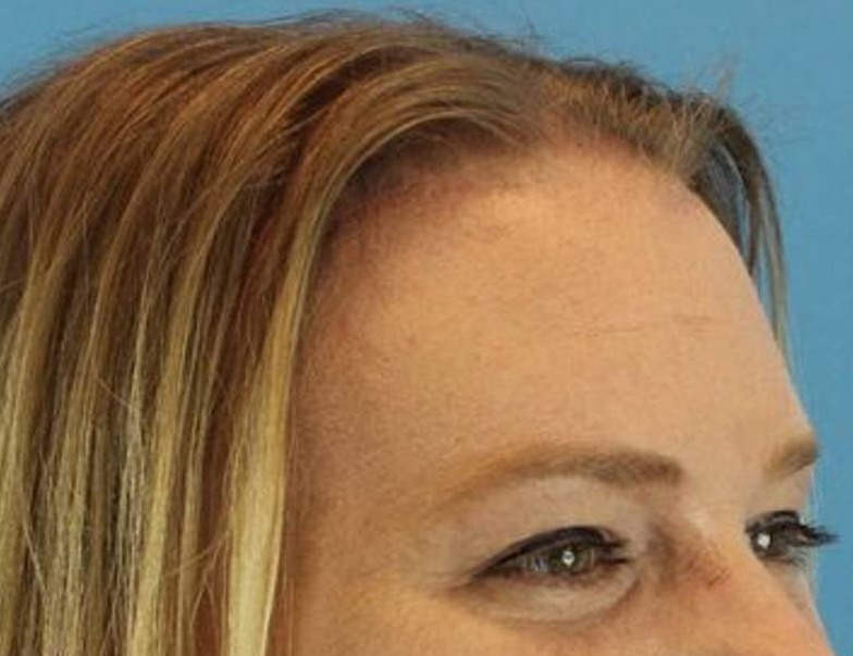 Brow Lift Before & After Image