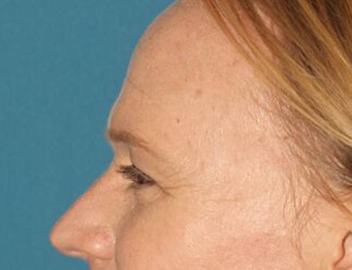 Brow Lift Before & After Image