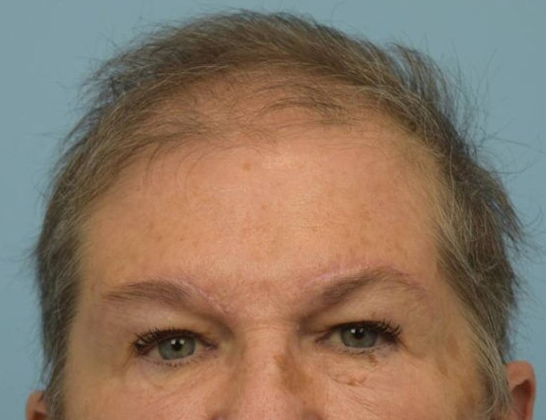 Brow Lift Before & After Image