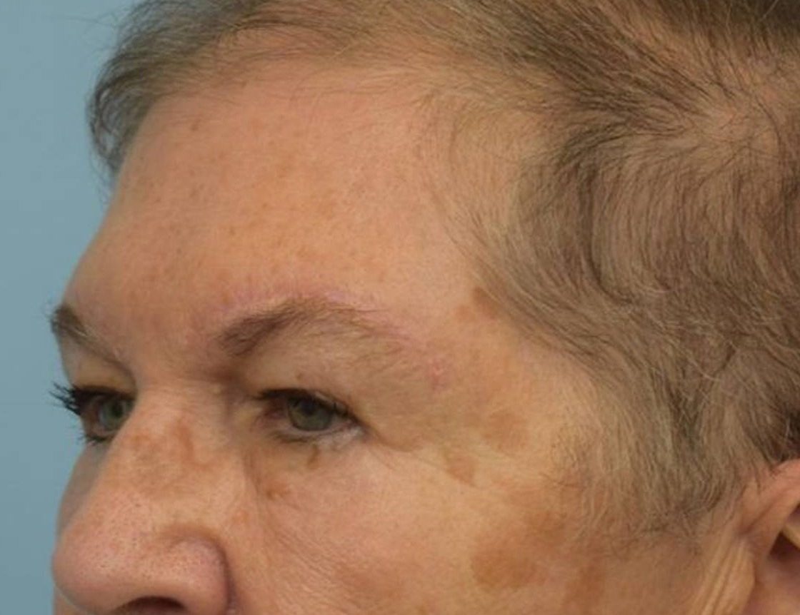 Brow Lift Before & After Image