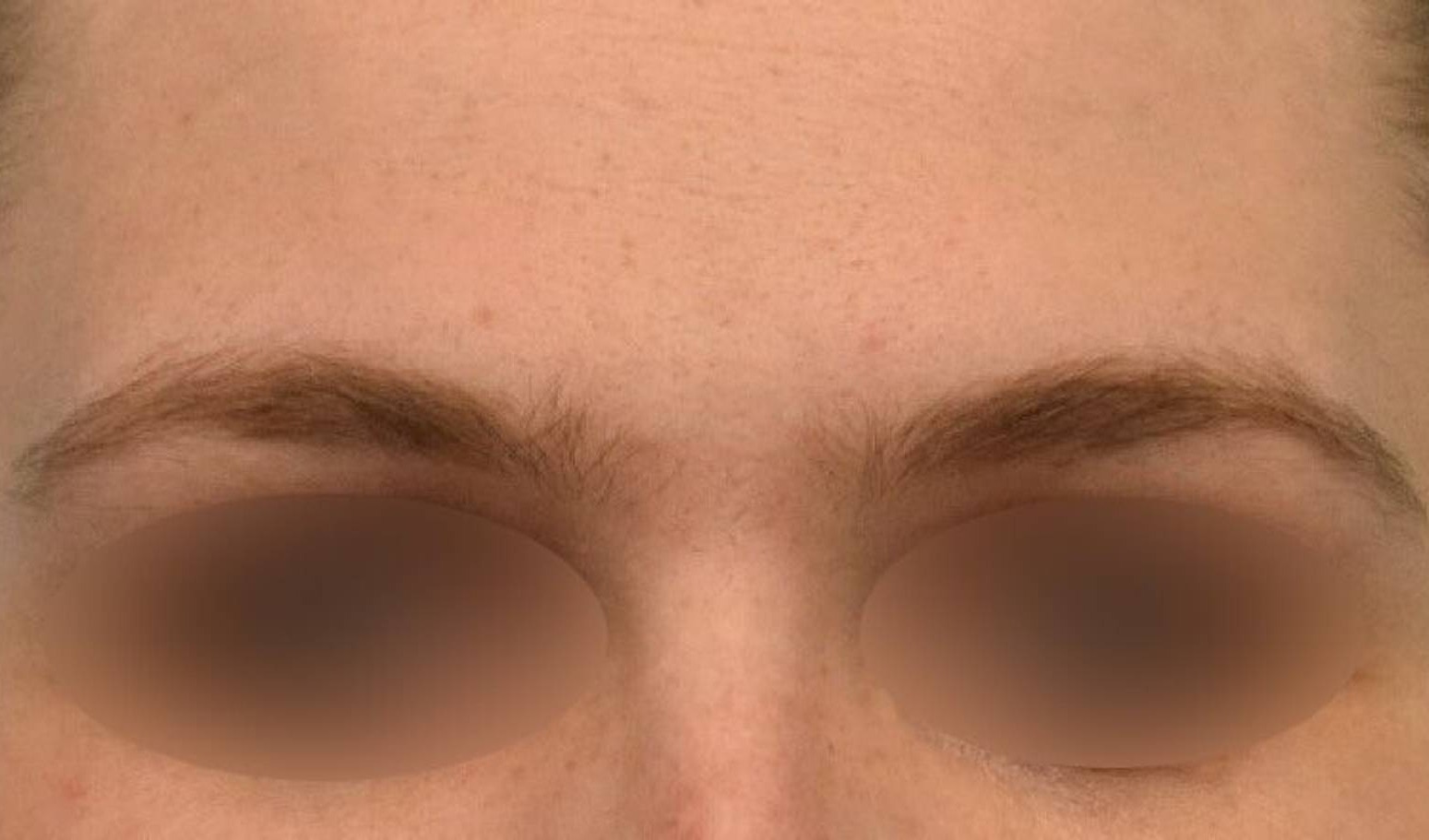 Brow Lift Before & After Image