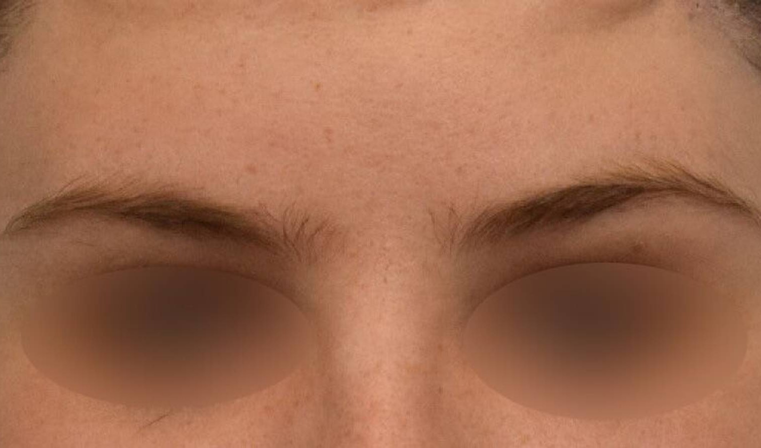 Brow Lift Before & After Image