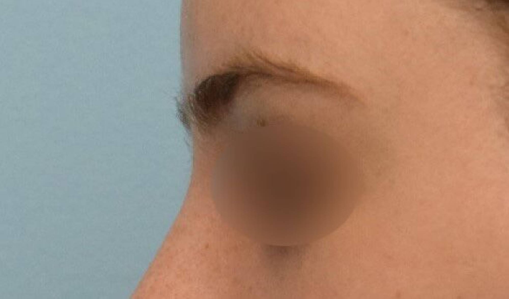 Brow Lift Before & After Image