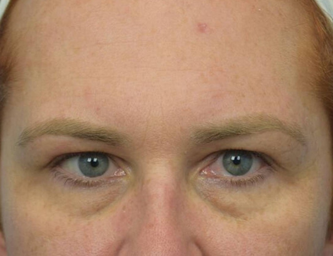 Brow Lift Before & After Image