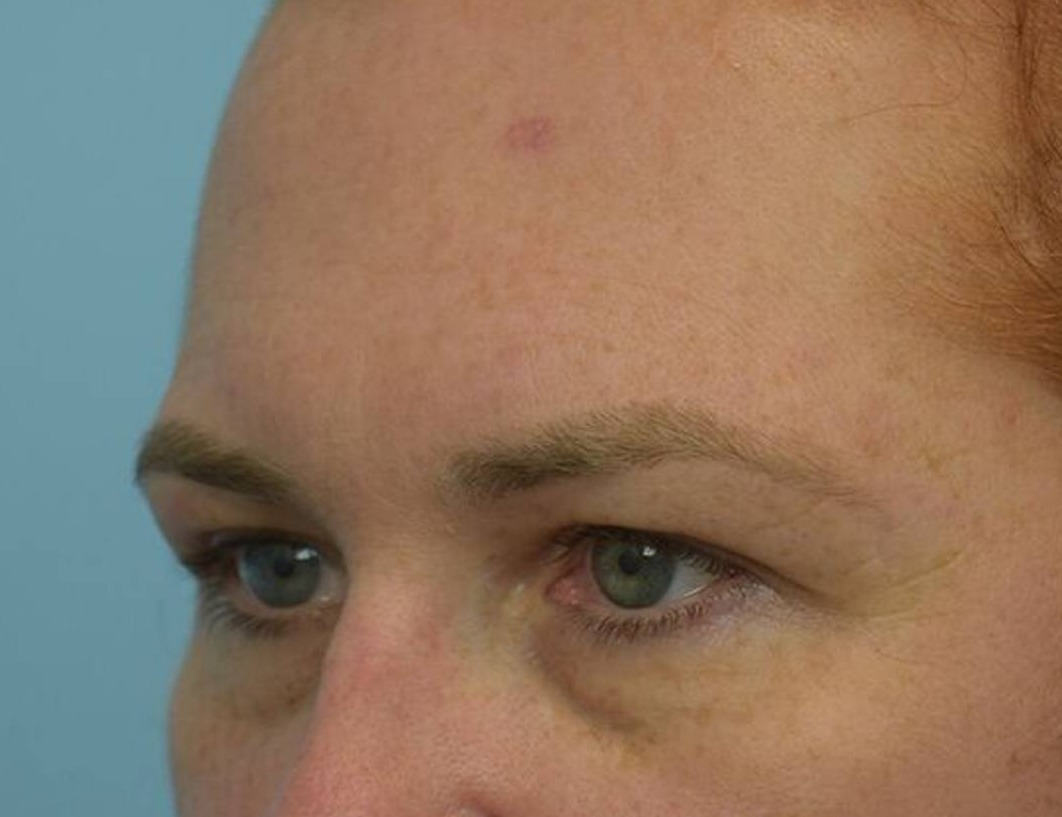 Brow Lift Before & After Image