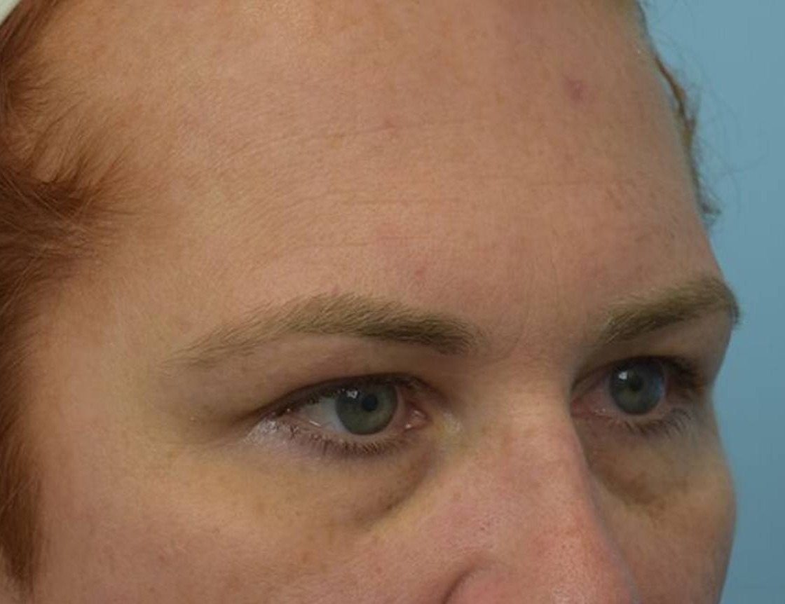 Brow Lift Before & After Image