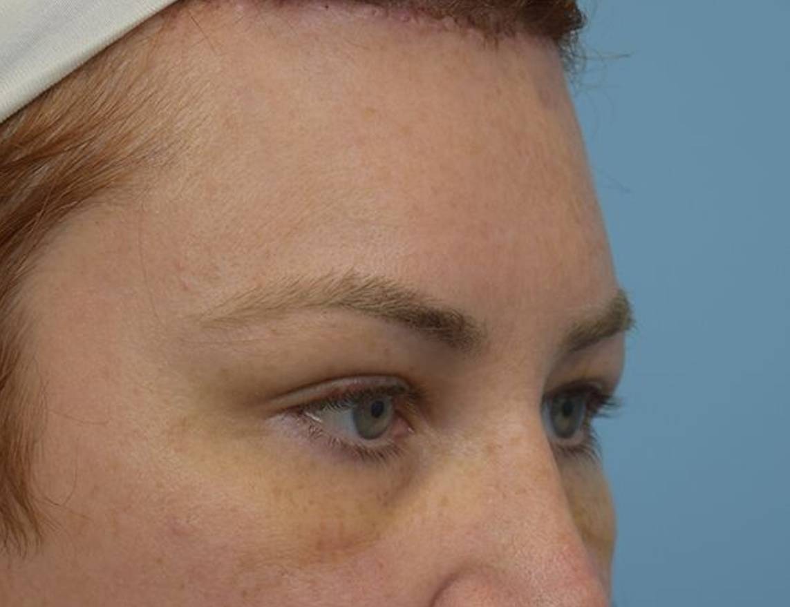 Brow Lift Before & After Image