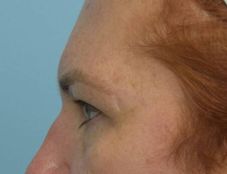 Brow Lift Before & After Image