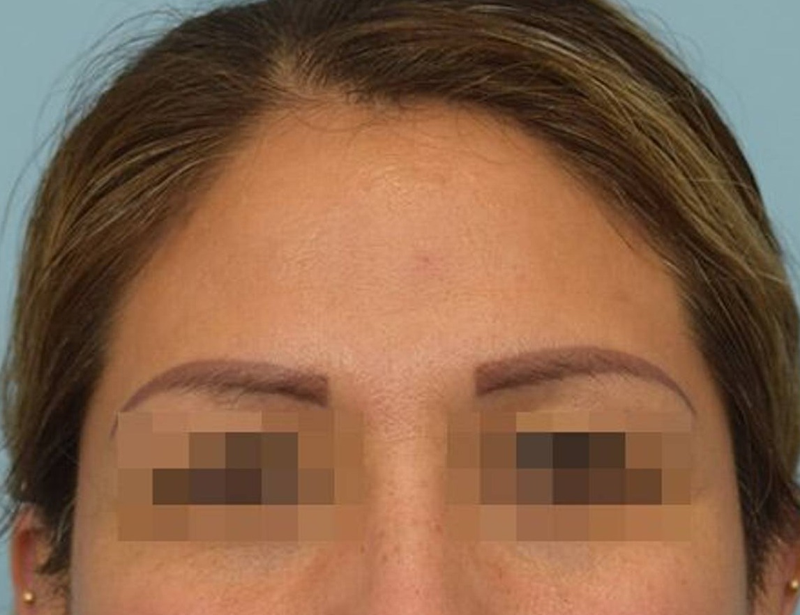 Brow Lift Before & After Image