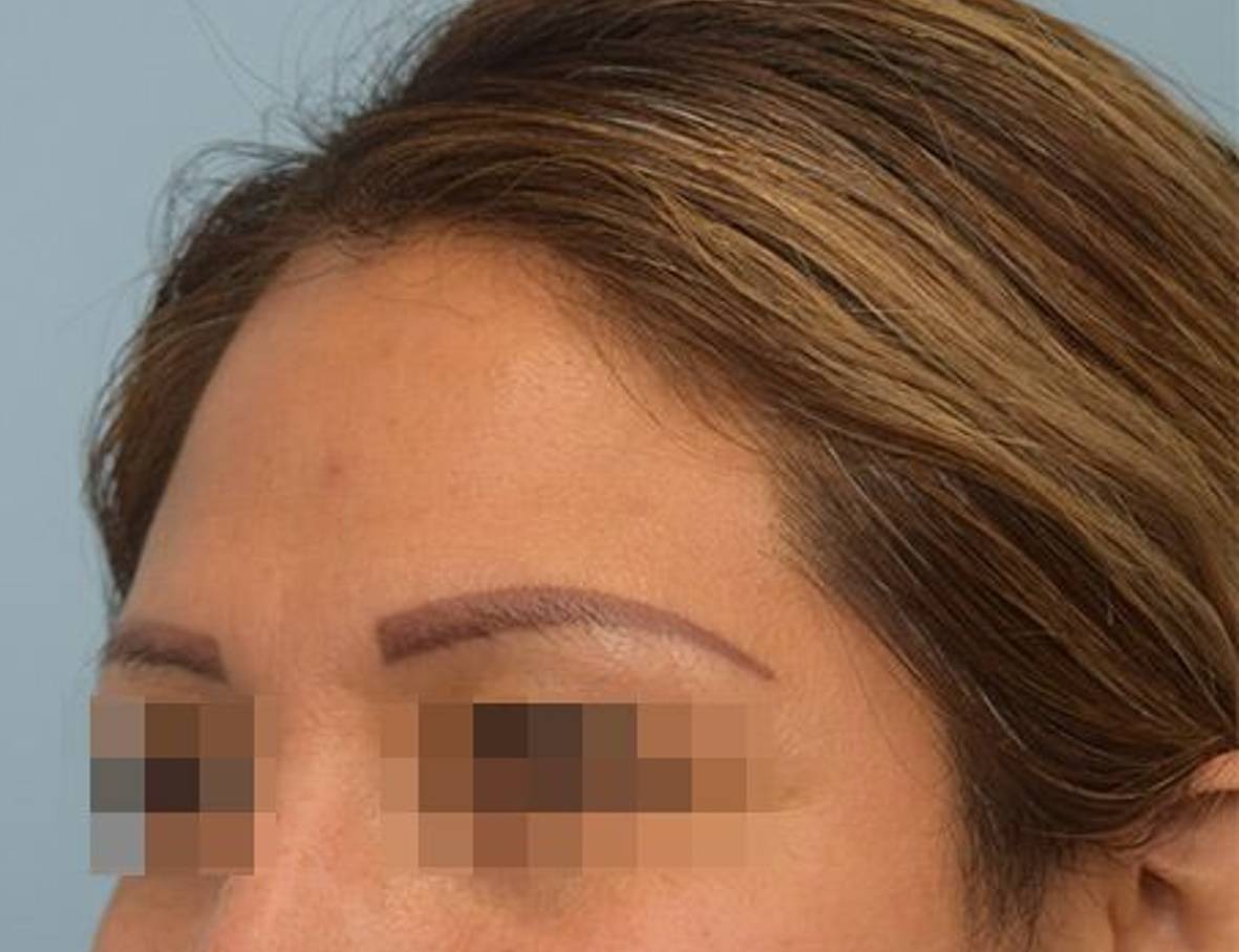 Brow Lift Before & After Image