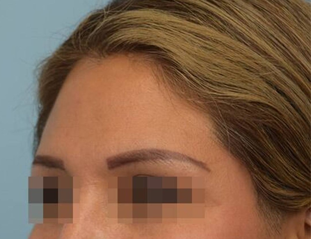 Brow Lift Before & After Image