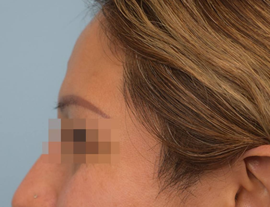 Brow Lift Before & After Image