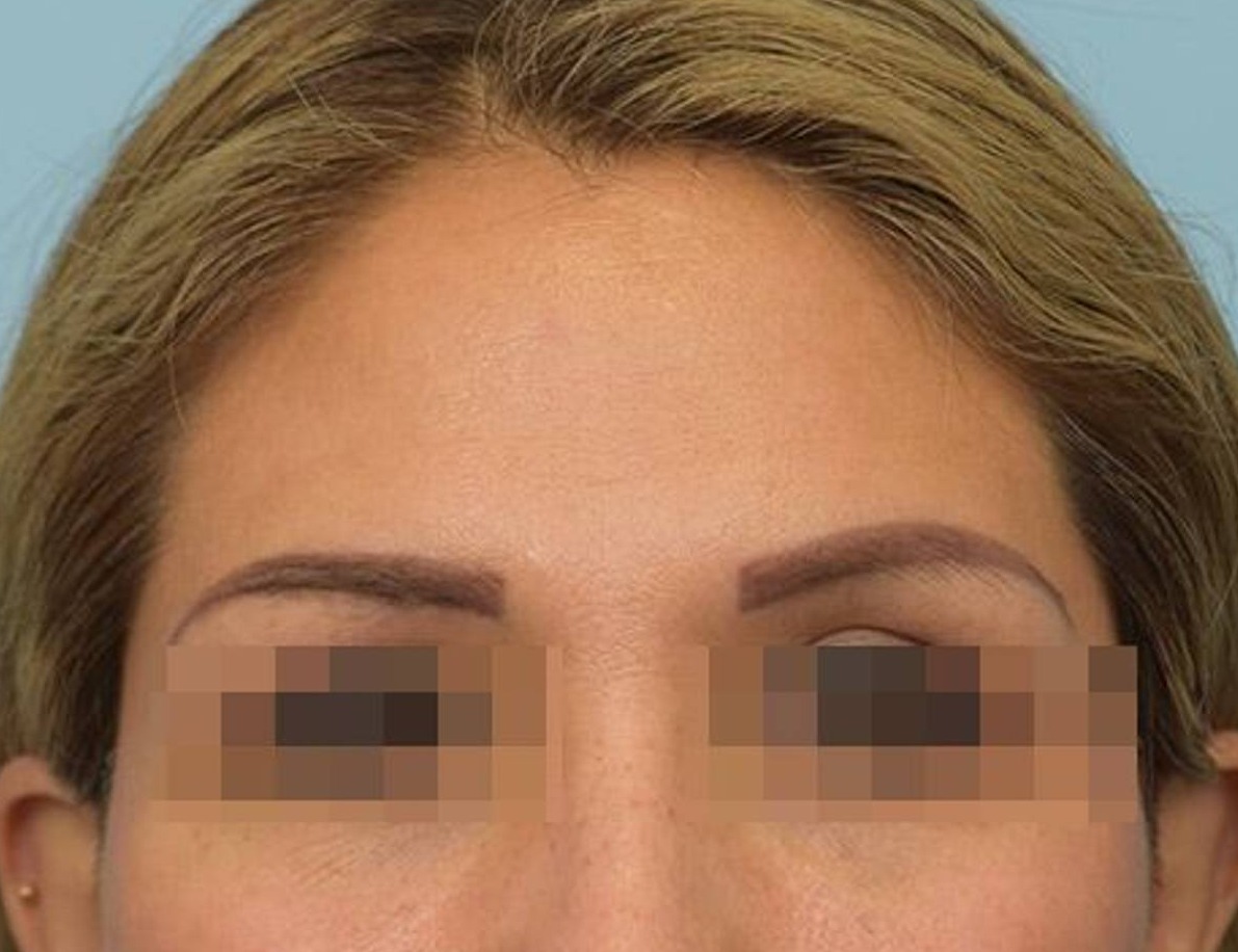 Brow Lift Before & After Image