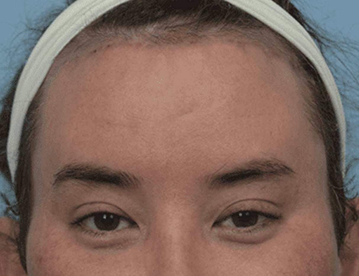 Brow Lift Before & After Image