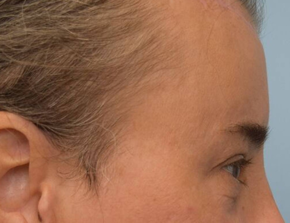 Brow Lift Before & After Image