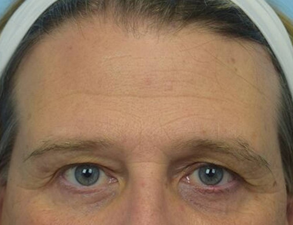 Brow Lift Before & After Image