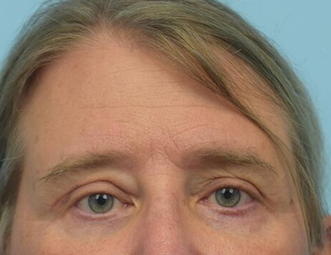 Brow Lift Before & After Image