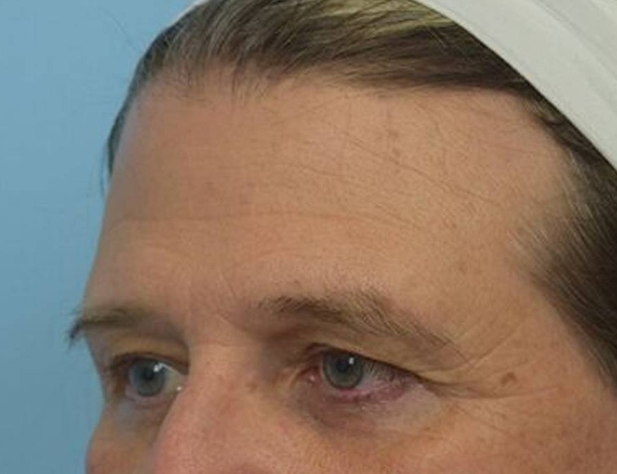 Brow Lift Before & After Image