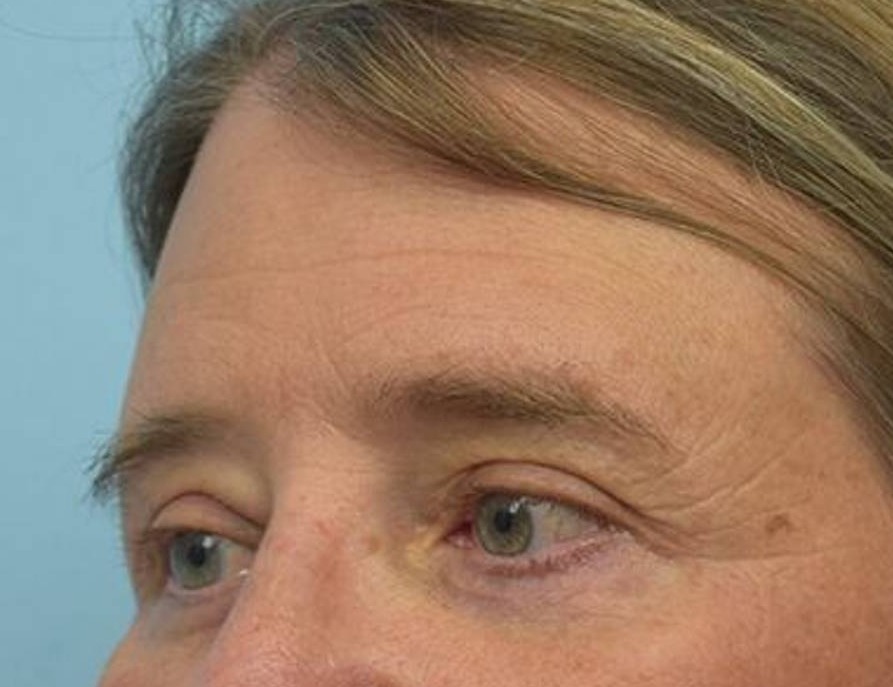 Brow Lift Before & After Image