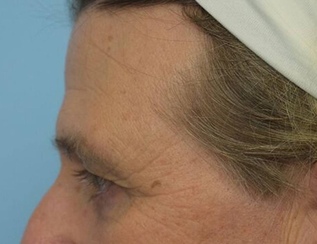 Brow Lift Before & After Image