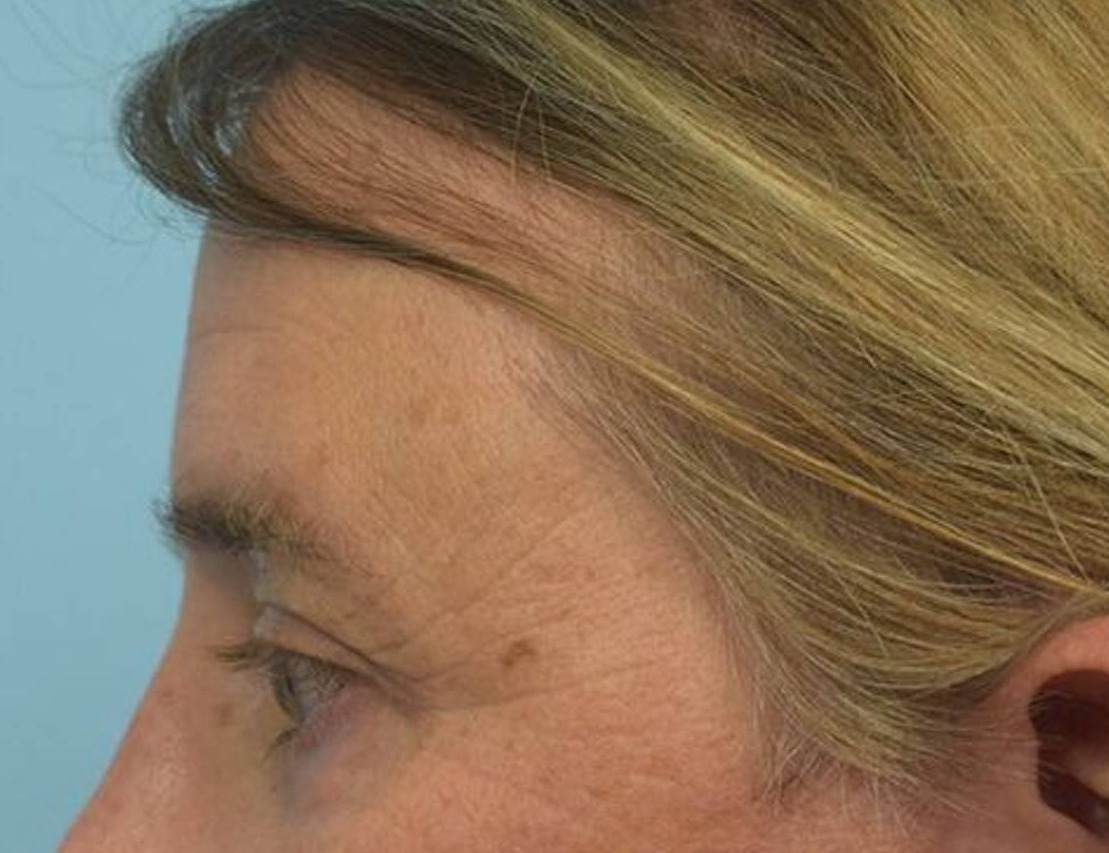 Brow Lift Before & After Image