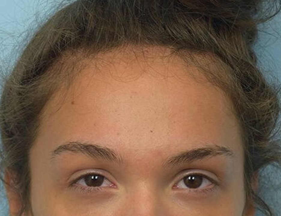 Brow Lift Before & After Image