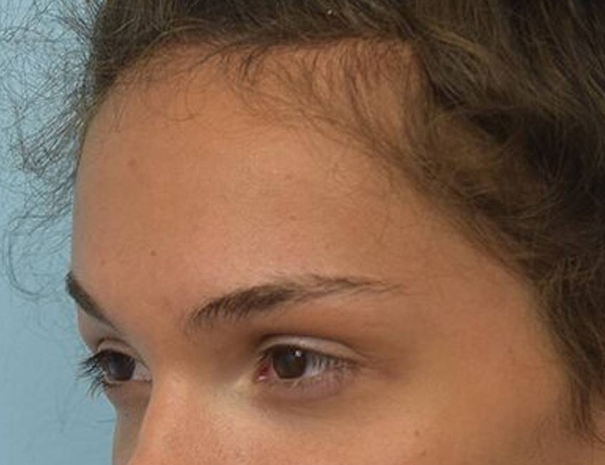 Brow Lift Before & After Image