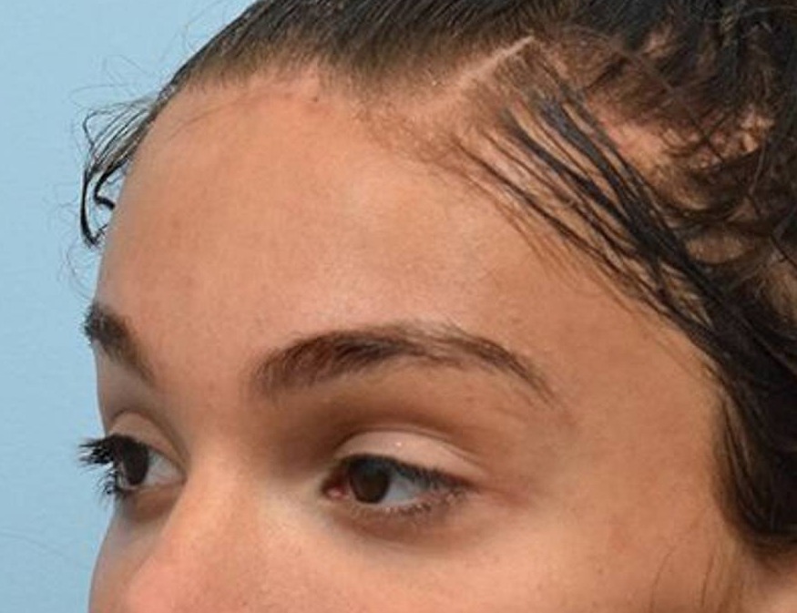 Brow Lift Before & After Image