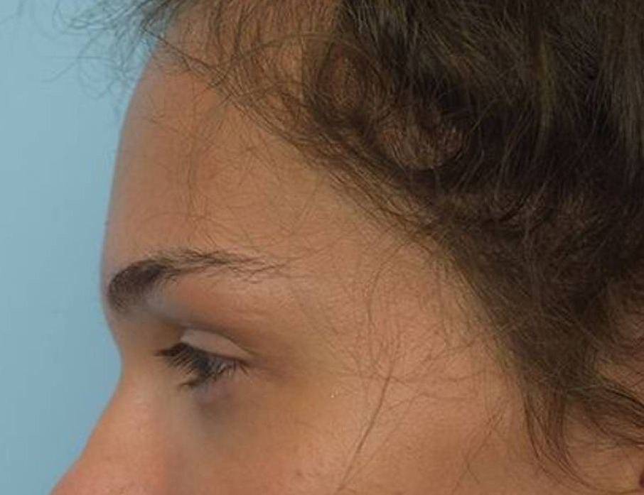 Brow Lift Before & After Image