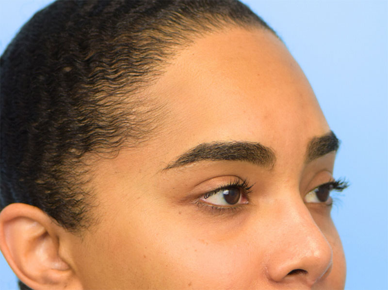 Brow Lift Before & After Image