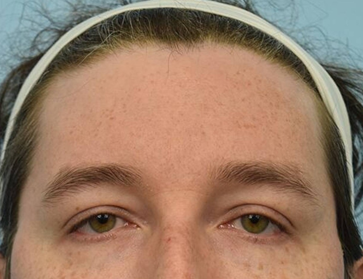 Brow Lift Before & After Image