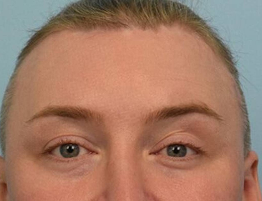 Brow Lift Before & After Image