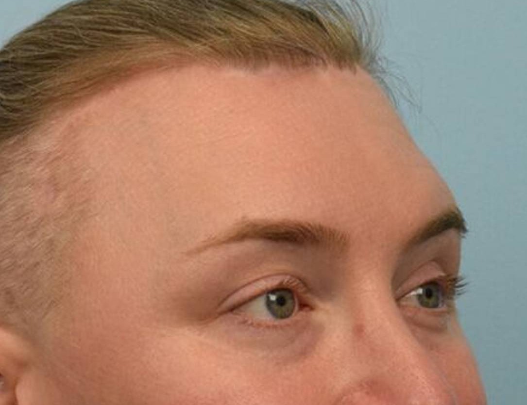 Brow Lift Before & After Image