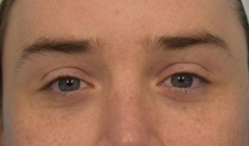 Brow Lift Before & After Image