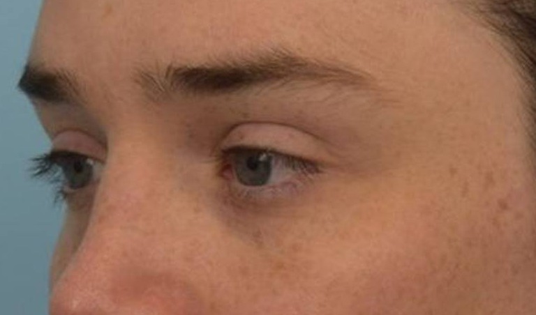 Brow Lift Before & After Image