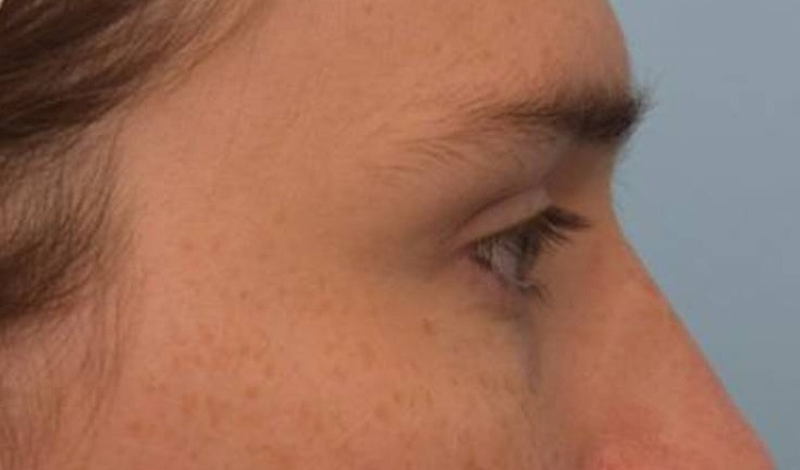 Brow Lift Before & After Image