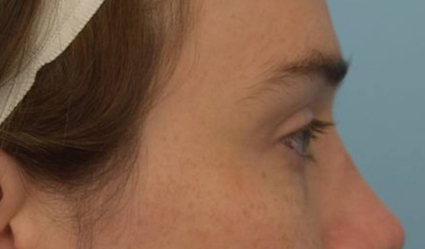 Brow Lift Before & After Image