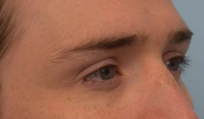 Brow Lift Before & After Image