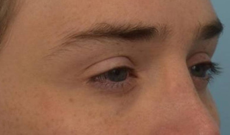 Brow Lift Before & After Image