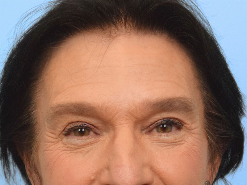 Brow Lift Before & After Image