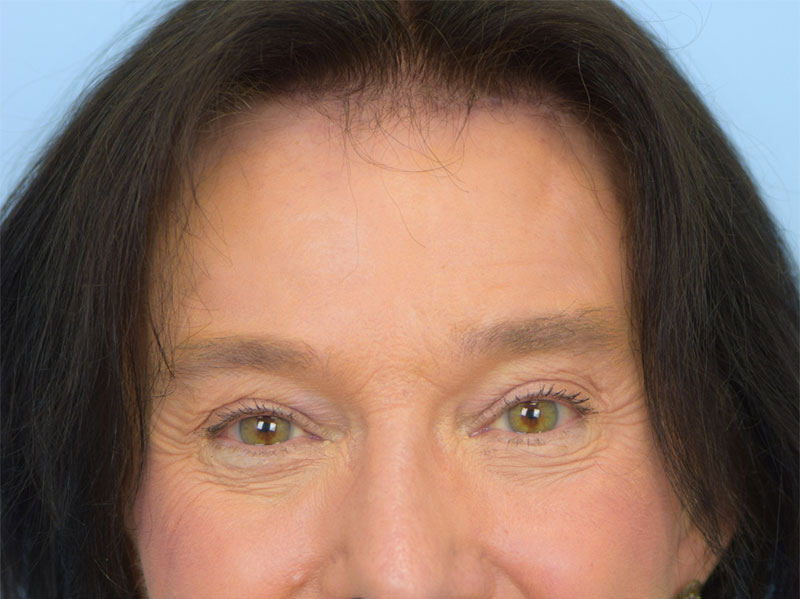 Brow Lift Before & After Image