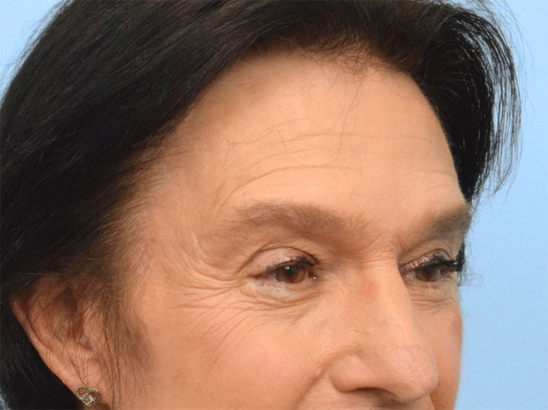 Brow Lift Before & After Image