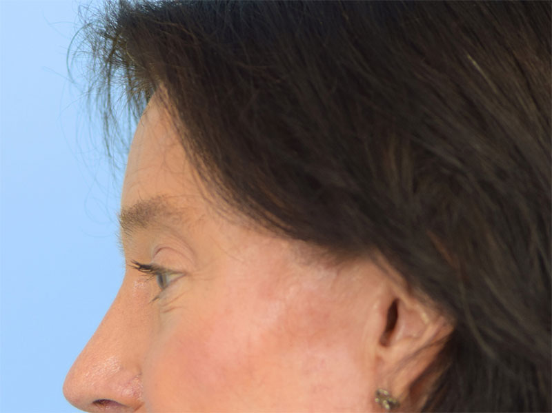 Brow Lift Before & After Image