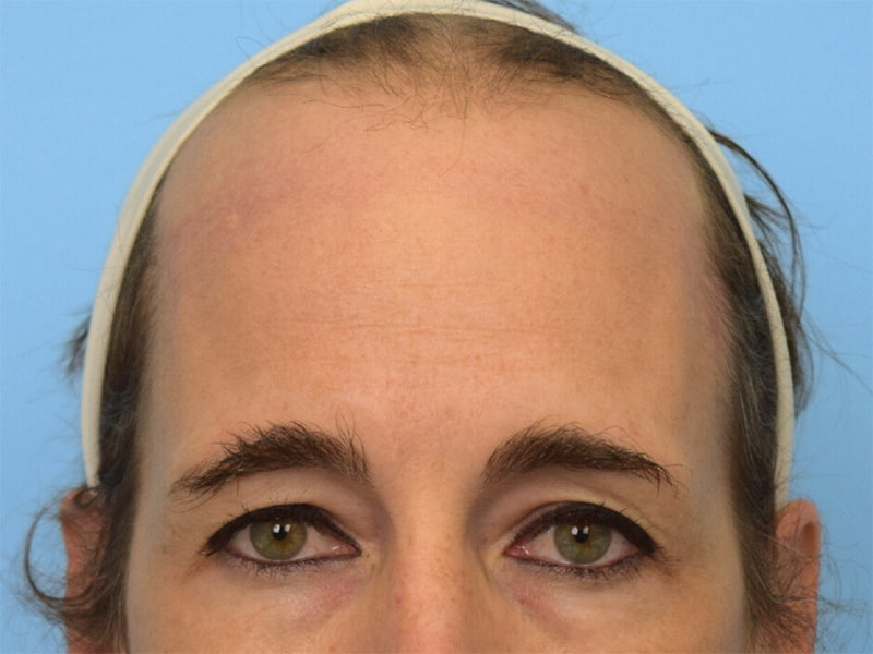 Brow Lift Before & After Image