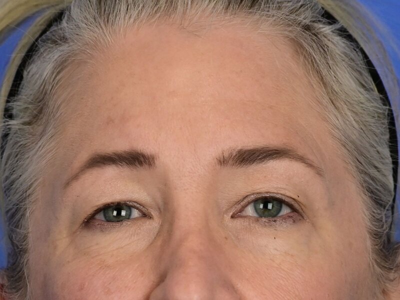 Brow Lift Before & After Image