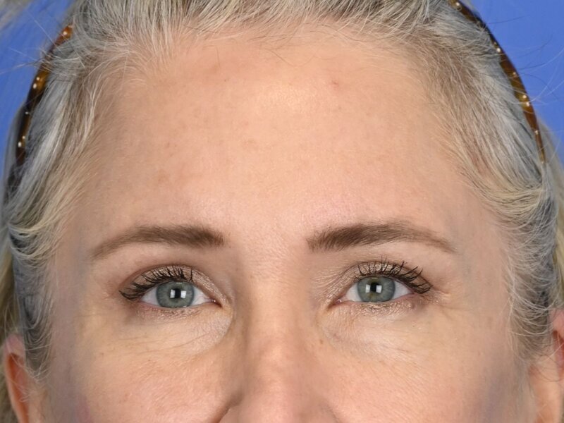 Brow Lift Before & After Image