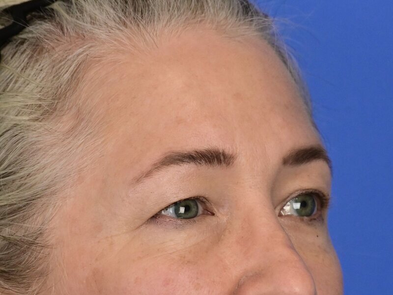 Brow Lift Before & After Image